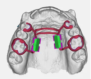 Distalizzatore Tooth Borne