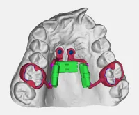 Espansore e Distalizzatore su 2 TADs 3 Viti