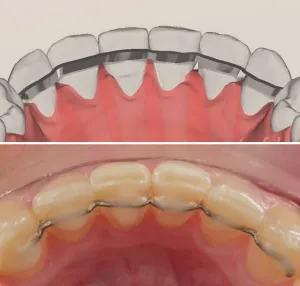 Retainer in Beta Titanio Biomedicale